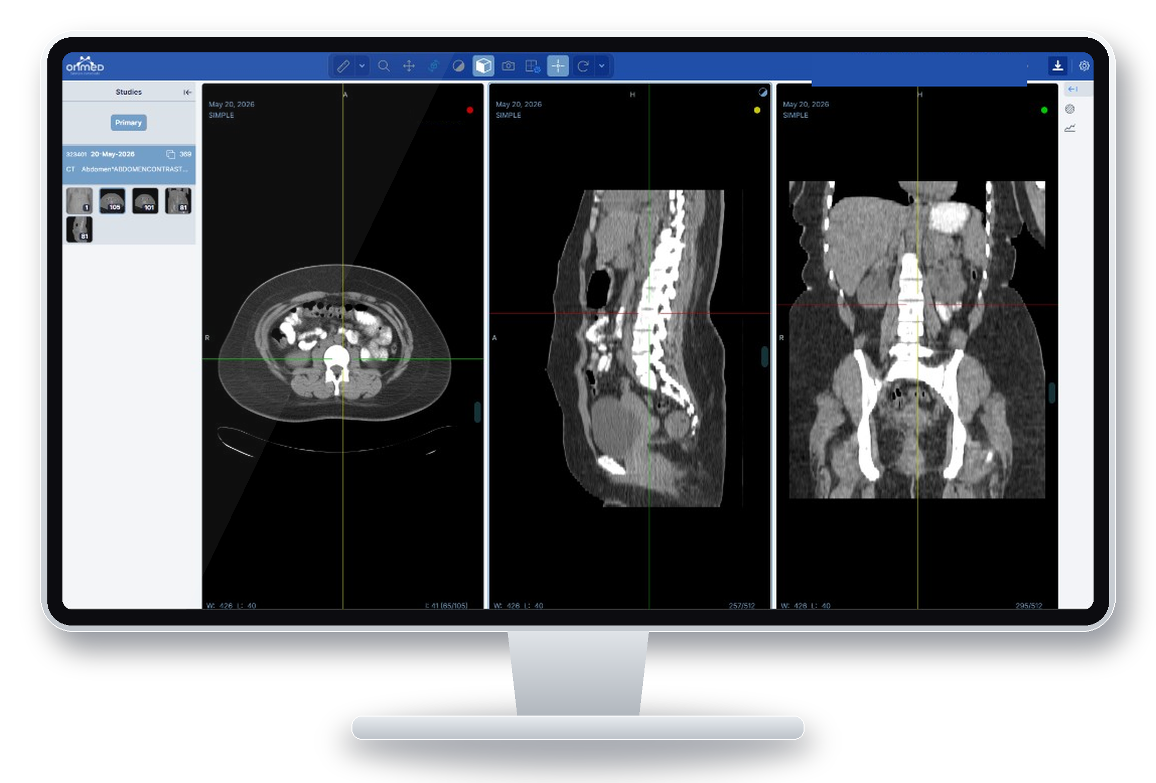 OnMed Visualizador en un monitor de escritorio: visor web DICOM con tomografía en reconstrucción multiplanar (MPR), vistas axial, sagital y coronal